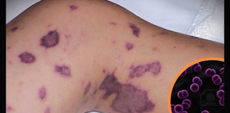 Loreto: Brote de meningitis deja fallecido a un menor de edad y 22 posibles contagios