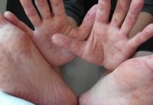 Brote de virus Coxsacckie en el norte del Perú